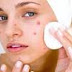 Wow,checkout this old but still active methods to get rid of pimples forever