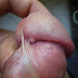 Cara Buang Ketuat Di Kemaluan thumbnail