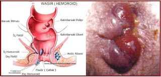 obat benjolan wasir ampuh tanpa operasi