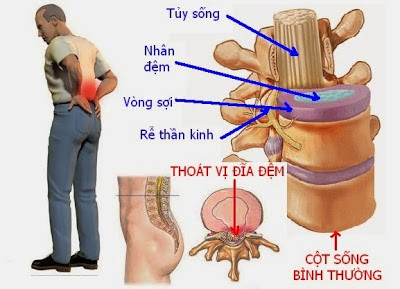 Biến chứng của thoát vị đĩa đệm chớ coi thường