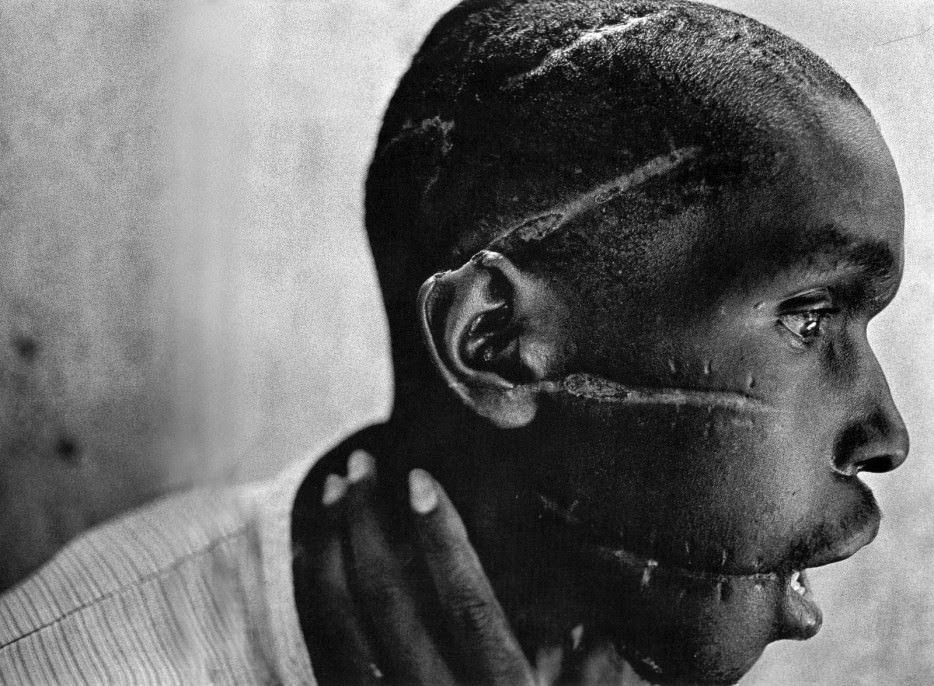 A Rwandan boy left scarred after being liberated from a death camp. - The 63 Most Powerful Photos Ever Taken That Perfectly Capture The Human Experience