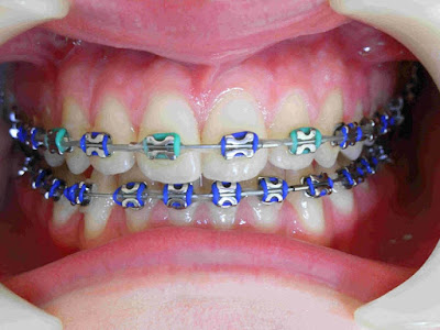 Tác dụng của phương pháp niềng răng