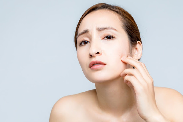 things-to-pay-attention-to-when-treating-acne-for-quick-skin-recovery