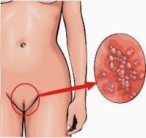 HPV Menular