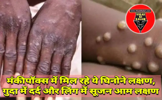 These disgusting symptoms are being found in monkeypox,