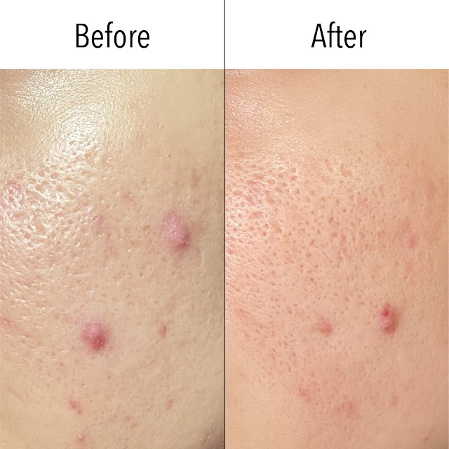 Before After ERHA Acne Centre