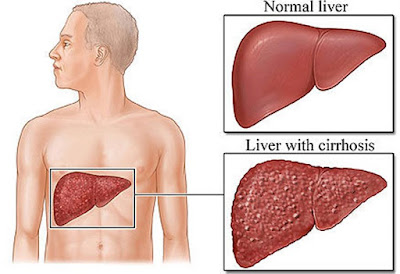 লিভাৰ চিৰচিচ কিয় হয়? লক্ষণ আৰু সাৱধানতা- chirrhosis in liver in Assamese