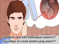 Obat Kutil Kelamin Yg Di Jual Di Apotik