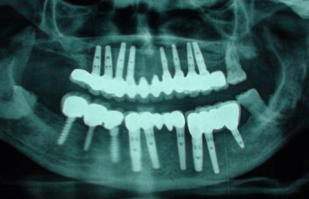 Rare But Dental Implant Failure Are Tied To Certain Health Factors