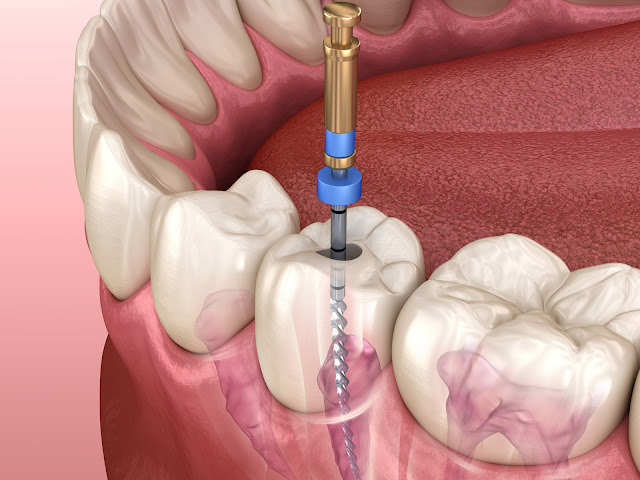 Global Root Canal Files Market Size