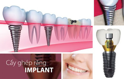 Kết hợp Implant với hàm tháo lắp hay răng sứ ?