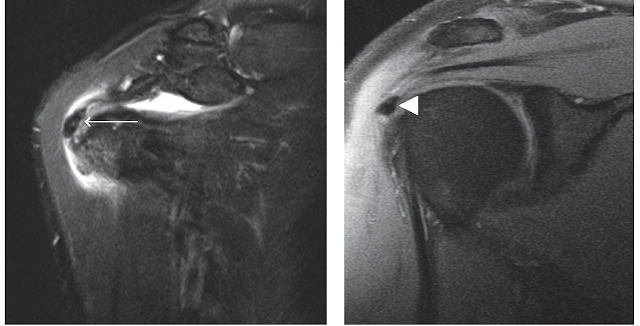 MRI Bệnh lắng đọng Calci Apatite