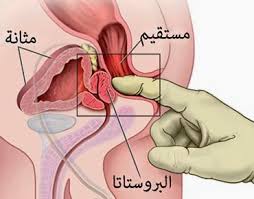 نتيجة بحث الصور عن احتقان البروستاتا