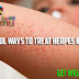  11 Powerful Ways to Treat Herpes Naturally