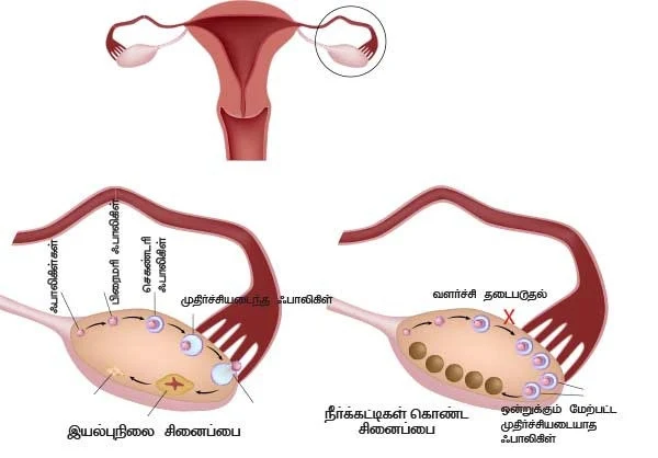 பாலிசிஸ்டிக் ஓவரி சின்ட்ரோம்