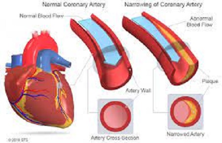 coronary artery disease icd 10