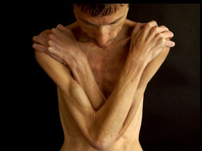 anorexia-Bryan Bixler