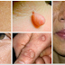 NATURAL WAYS TO DESTROY MOLES, WARTS, BLACKHEADS, SKIN TAGS AND AGE SPOTS