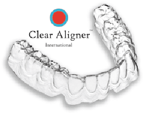 Giá niềng răng không mắc cài invisalign