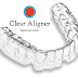 Giá niềng răng không mắc cài invisalign