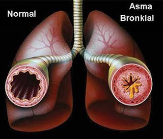 obat herbal asma resep dokter di apotik umum