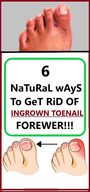 Treat Your Ingrown Toenail With These 6 Natural and Homemade Remedies