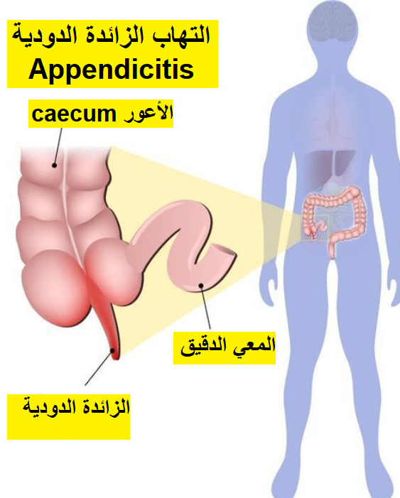 التهاب الزائدة الدودية Appendicitis