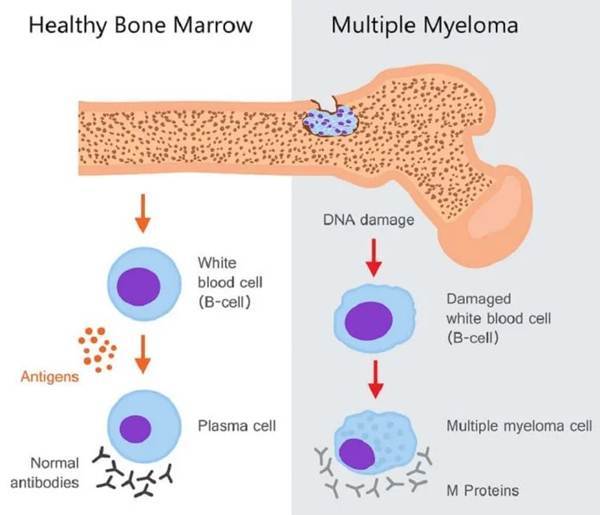 Multiple Myeloma - Penyebab, Gejala dan Pengobatan