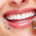 Tẩy trắng răng bằng tia laser có hại không ?