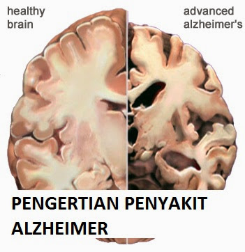 Alzheimer