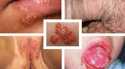 Cara Menghilangkan Bekas Herpes Simplex