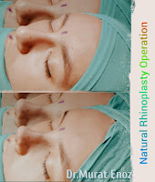 nose job,Natural rhinoplasty in Istanbul,Natural looking nasal aesthetic surgery,nose reshaping,