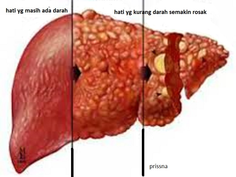 Pusat Rawatan (PRISSNA): HATI BENGKAK