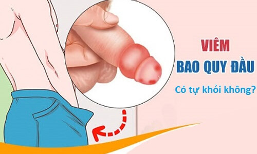 cắt bao quy đầu có bị vô sinh không