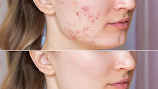 पिम्पल का घरेलू उपचार Pimple Skin Care Tips in Hindi