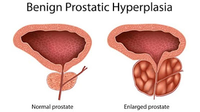  prostate enlargement treatment in tamil nadu, chennai