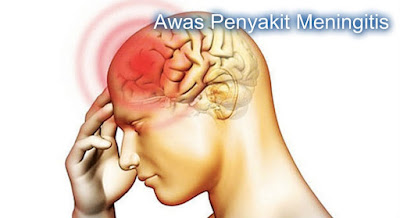 Bisakah Meningitis Kambuh Lagi?