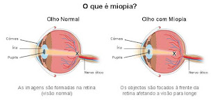 causa miopia, miopia e astigmatismo, miopia graus, miopia tem cura, miopia operação, miopia cirurgia, miopia sintomas, o que é astigmatismo, curar miopia de forma natural
