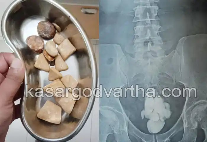 Kerala News, Kasaragod News, Malayalam News, Treatment, Surgery, Stone Removed, Health Issues, Kasaragod: 200 gram stone surgically removed from patient's bladder.
