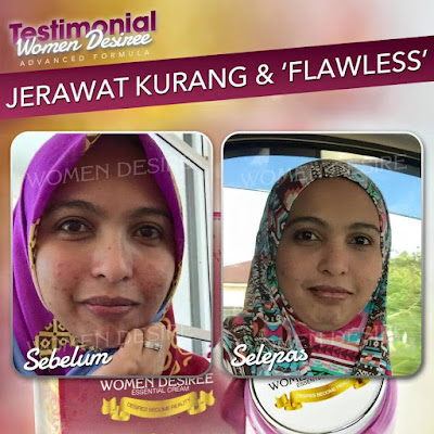 TESTIMONI JERAWAT KURANG DENGAN WDEC