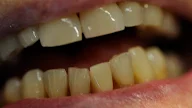 Whats A Flipper Tooth : A flipper tooth, or temporary partial denture, is a dental product designed to fill the gaps in your smile that exist through tooth removal, decay, or injury.