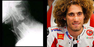 Heboh!! Foto Hasil Rontgen Simoncelli 