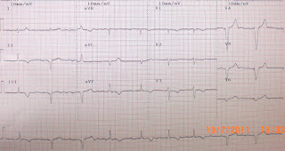   ekg คือ, ekg ผิดปกติ, ekg 12 lead ปกติ, normal sinus rhythm คือ, basic ekg, p wave คือ, การติด ekg monitor, กราฟคลื่นหัวใจผิดปกติ, ekg ย่อมาจาก