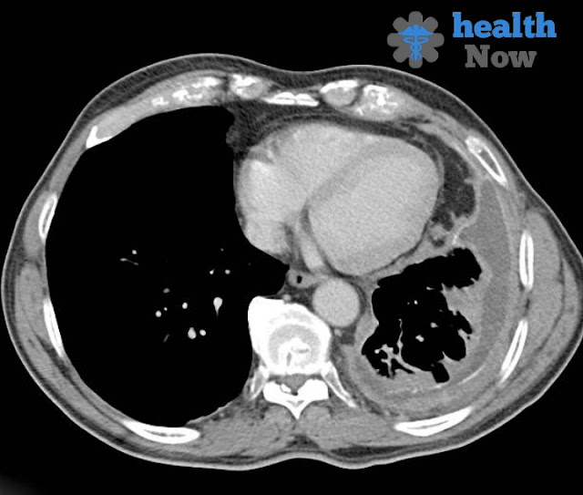 What is mesothelioma disease. Diagnosis and how it is treated.