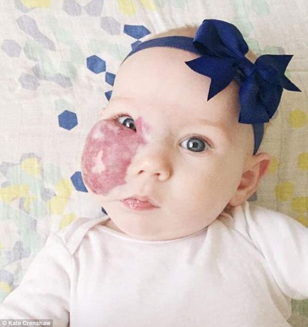 Mom of girl with large red birthmark across her face slams ...