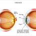  Cara Mengobati Penyakit Katarak