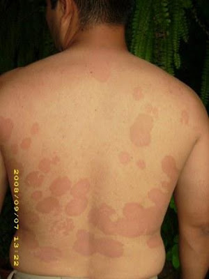 Psoriasis