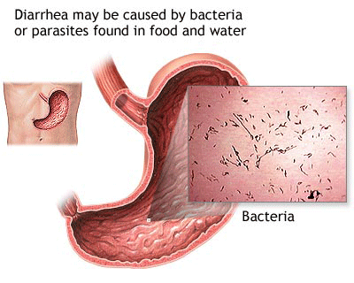 Hemolytic Uremic Syndrome. Hemolytic-uremic syndrome