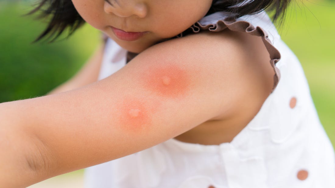 Mosquito-bites:-how-to-relieve-them-?