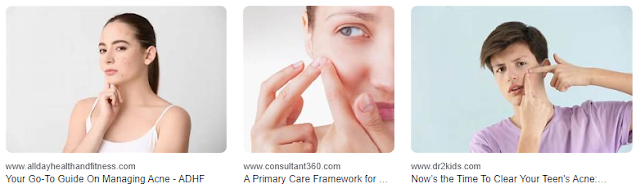 Tips for Managing Acne in Adolescents